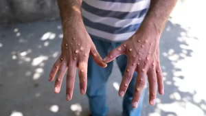 Monkeypox Hero