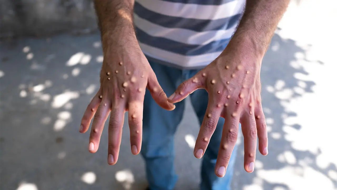Monkeypox Hero